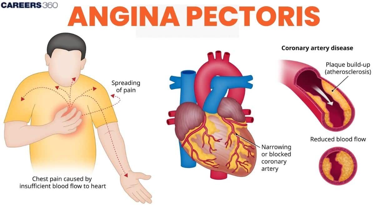 Angina pectoris - causes, Symptoms, Treatment